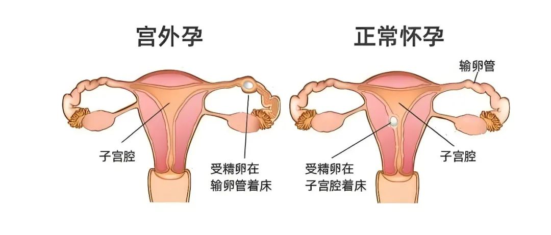宫内早孕是什么意思