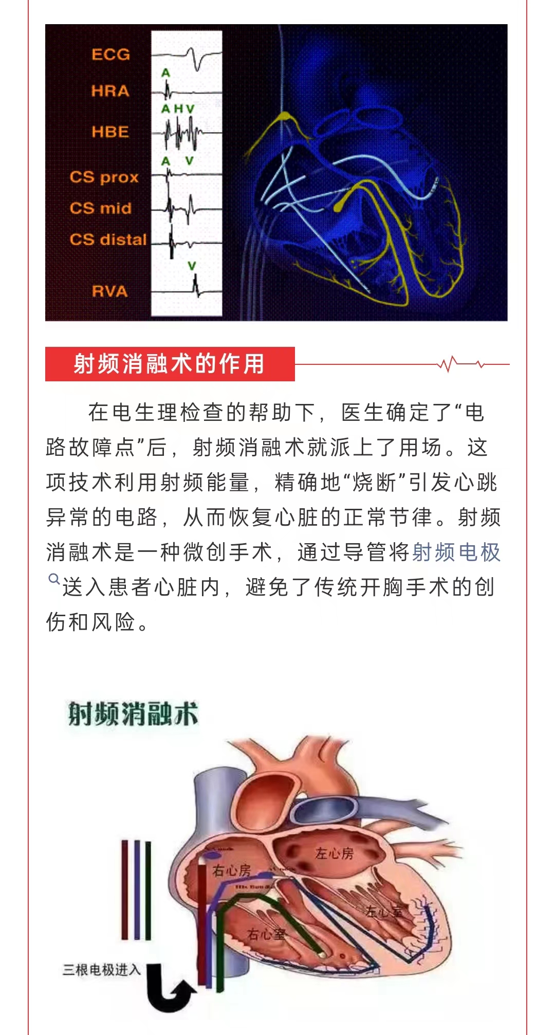 射频消融术有危险吗