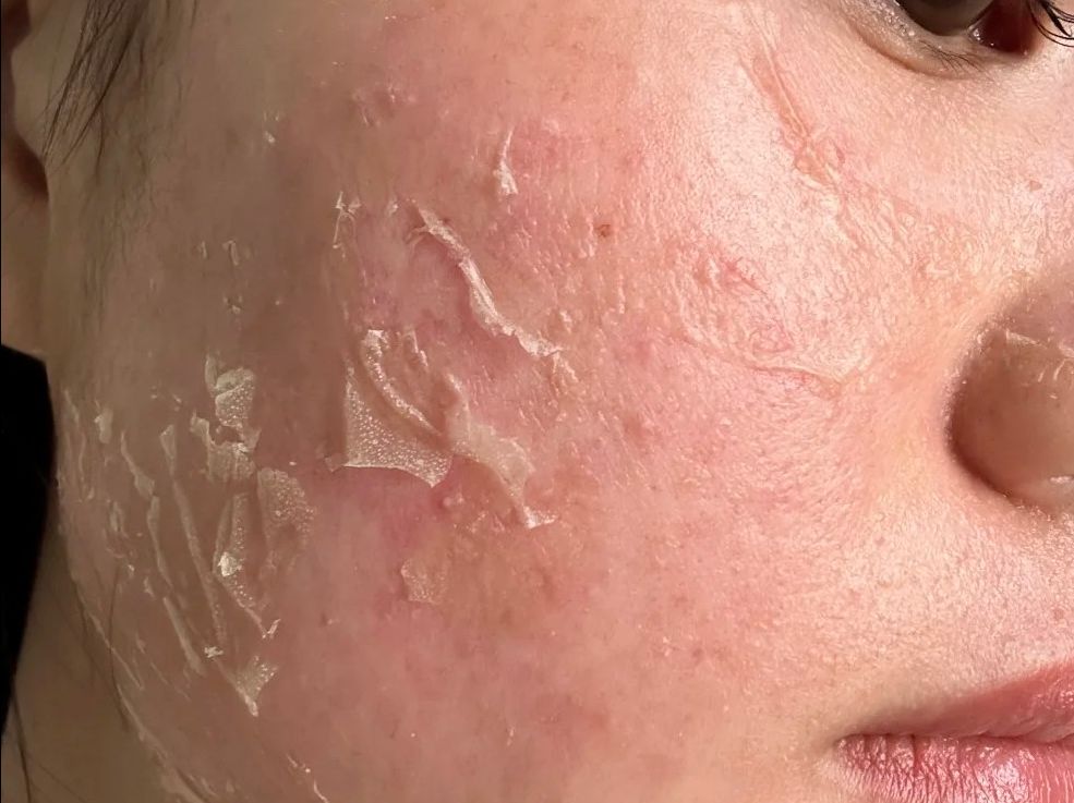 洗完脸后脸上起皮怎么治