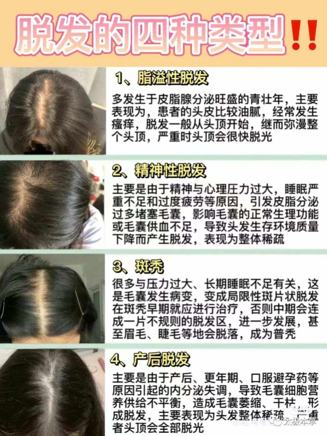 斑秃擦生姜的方法