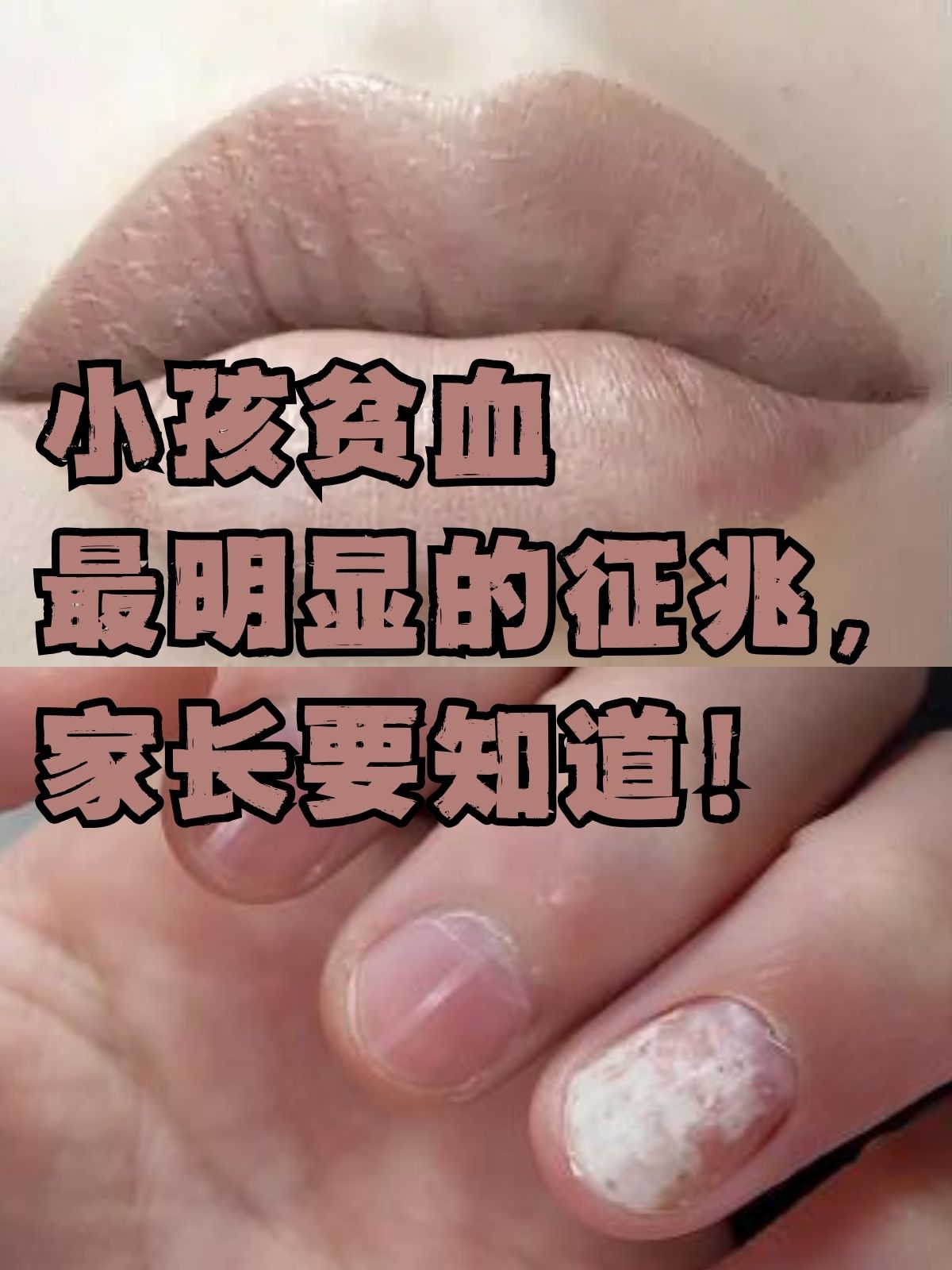 严重贫血有什么症状