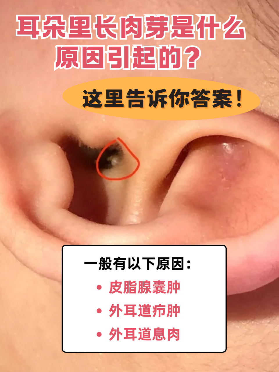 粉瘤是怎么回事