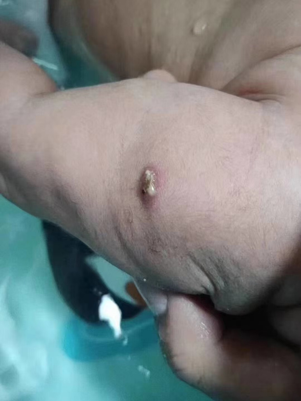 打了卡介苗后的正常反应是什么?