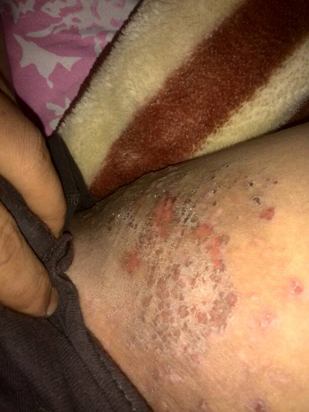 男性大腿根部湿疹图片症状表现