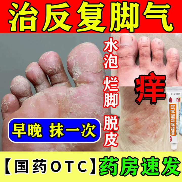 脚丫烂用什么药比较好