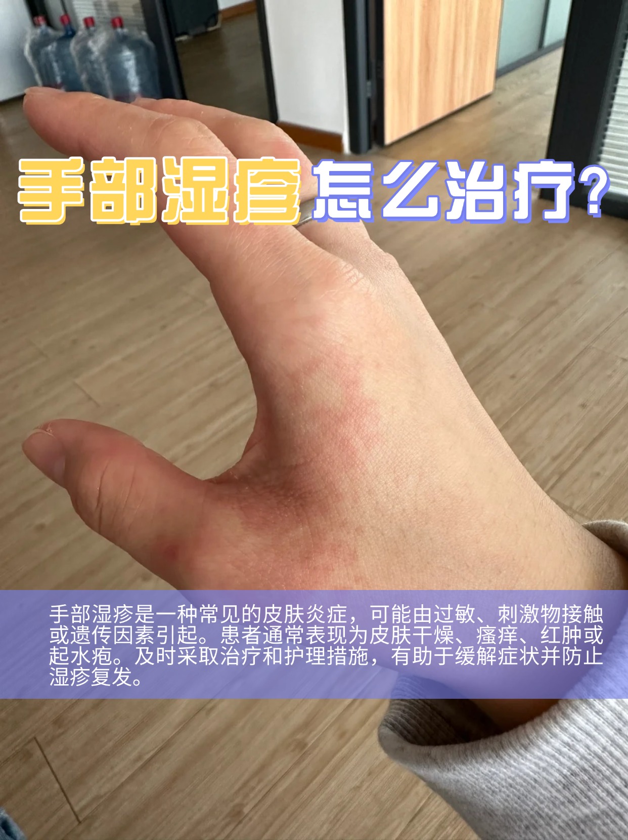手湿疹怎么治