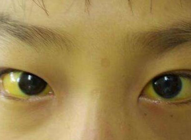 黄疸有哪些症状?