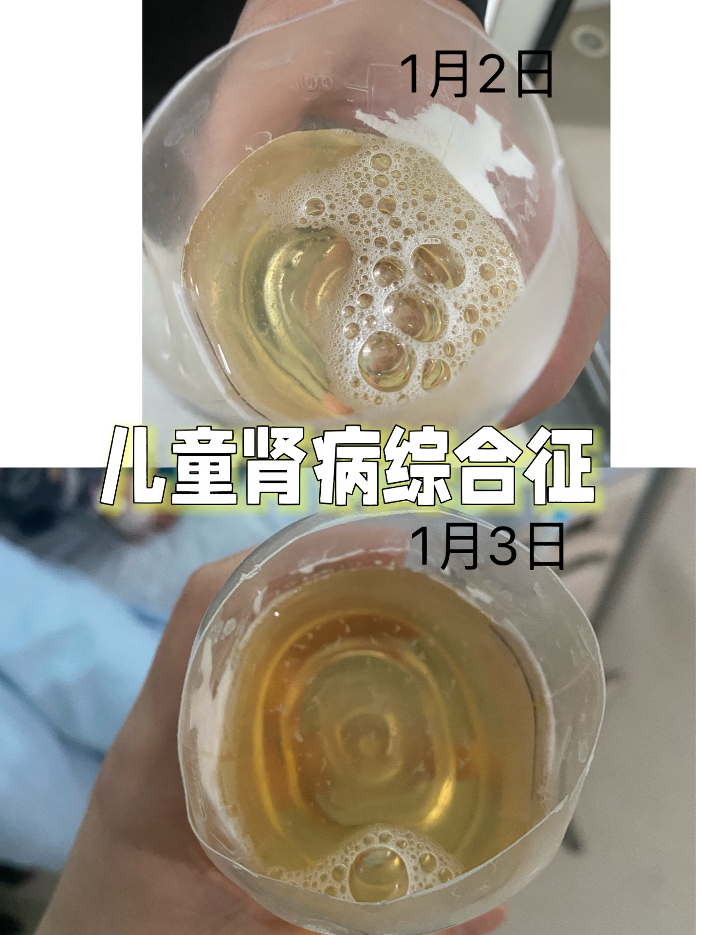 肾病综合征指什么