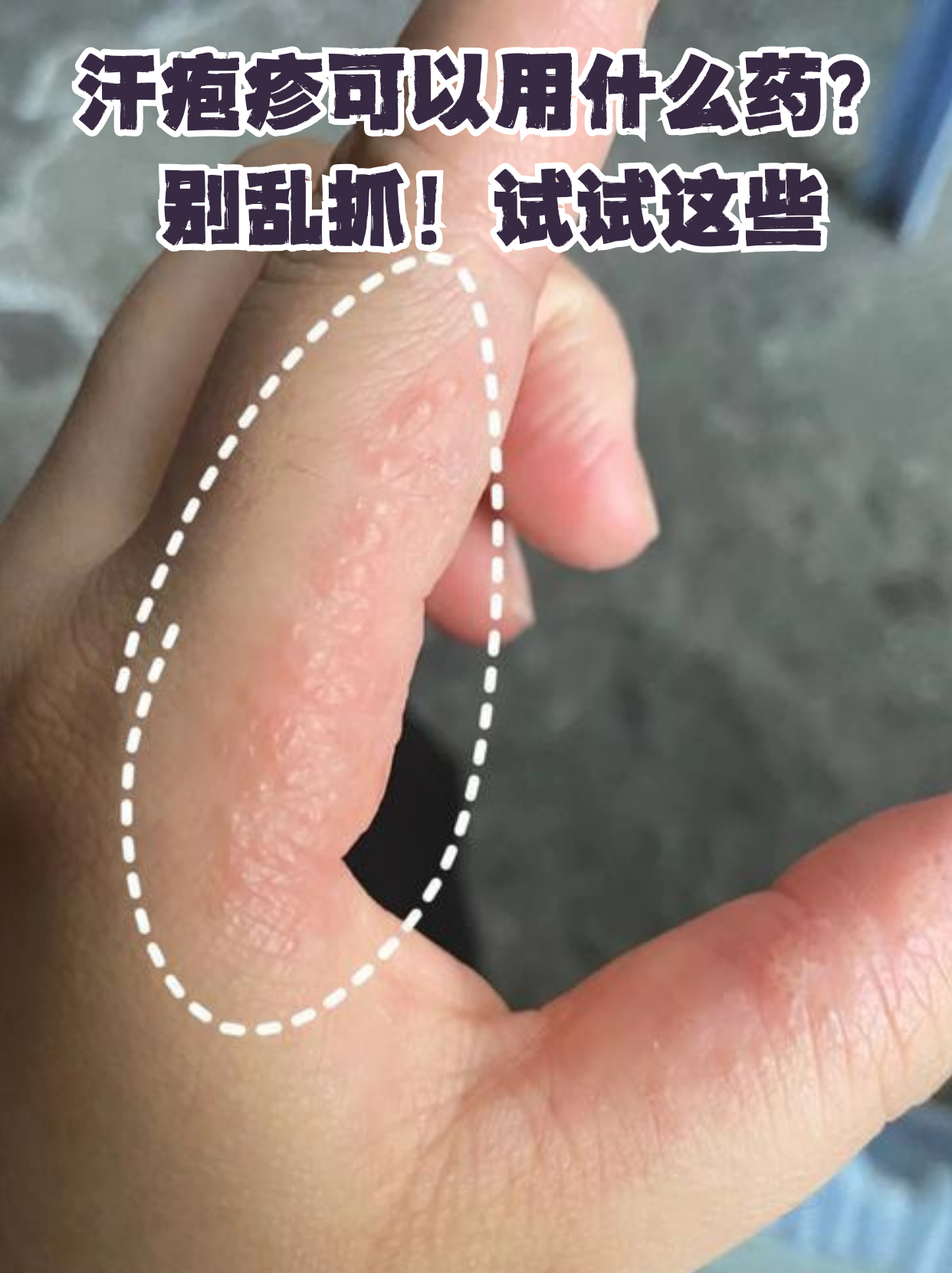 手上长小水泡很痒怎么办