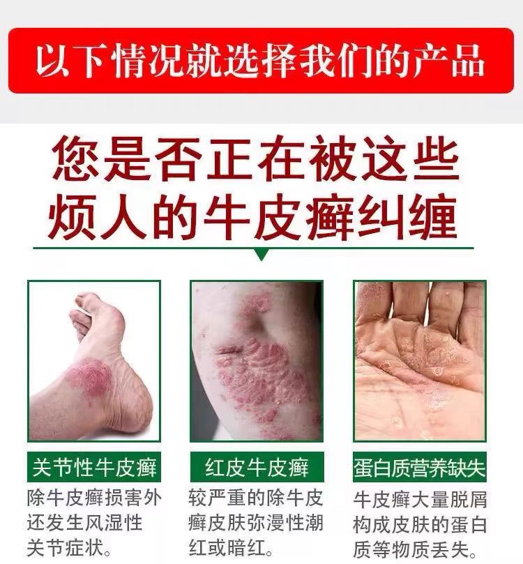 牛皮癣的特效药