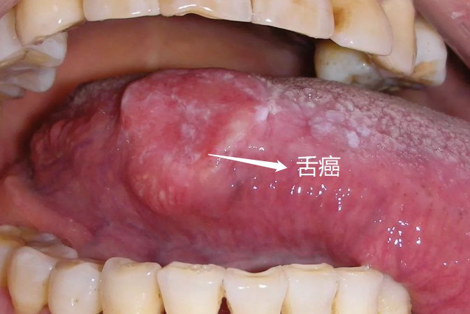 舌癌都有哪些症状表现
