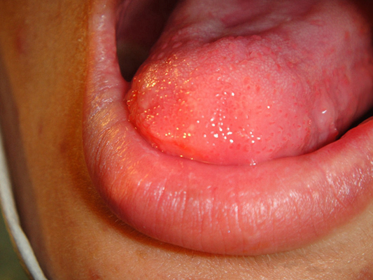 舌癌都有哪些症状表现