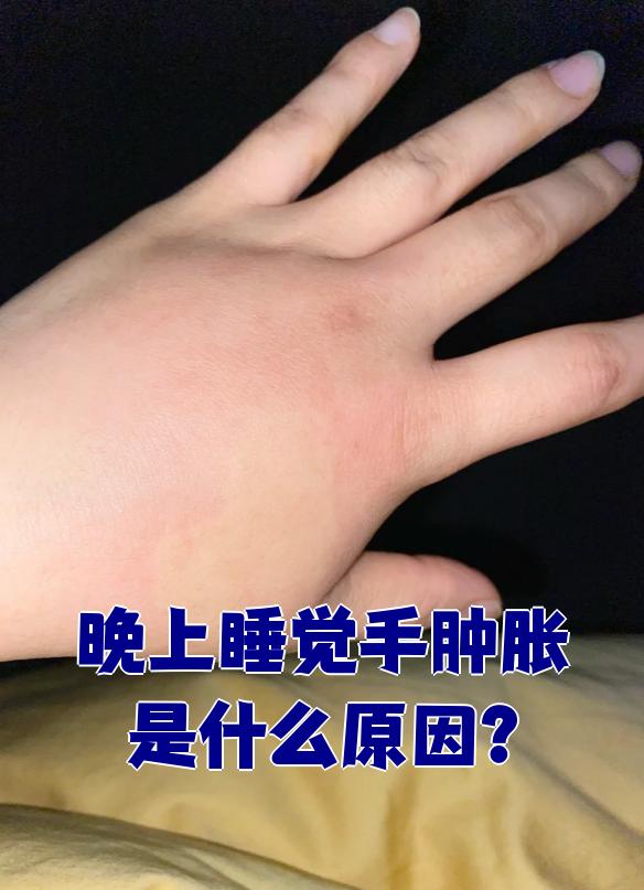 手疼手肿什么回事