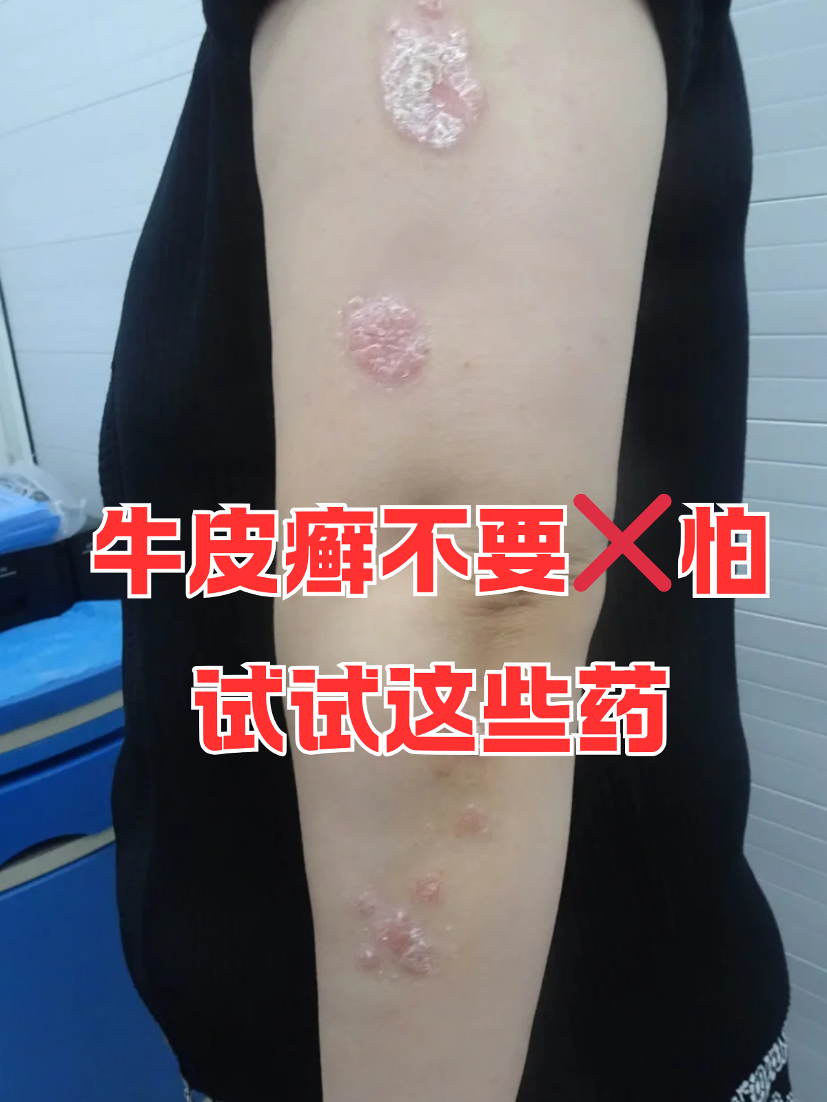 银屑病的治疗偏方有哪些