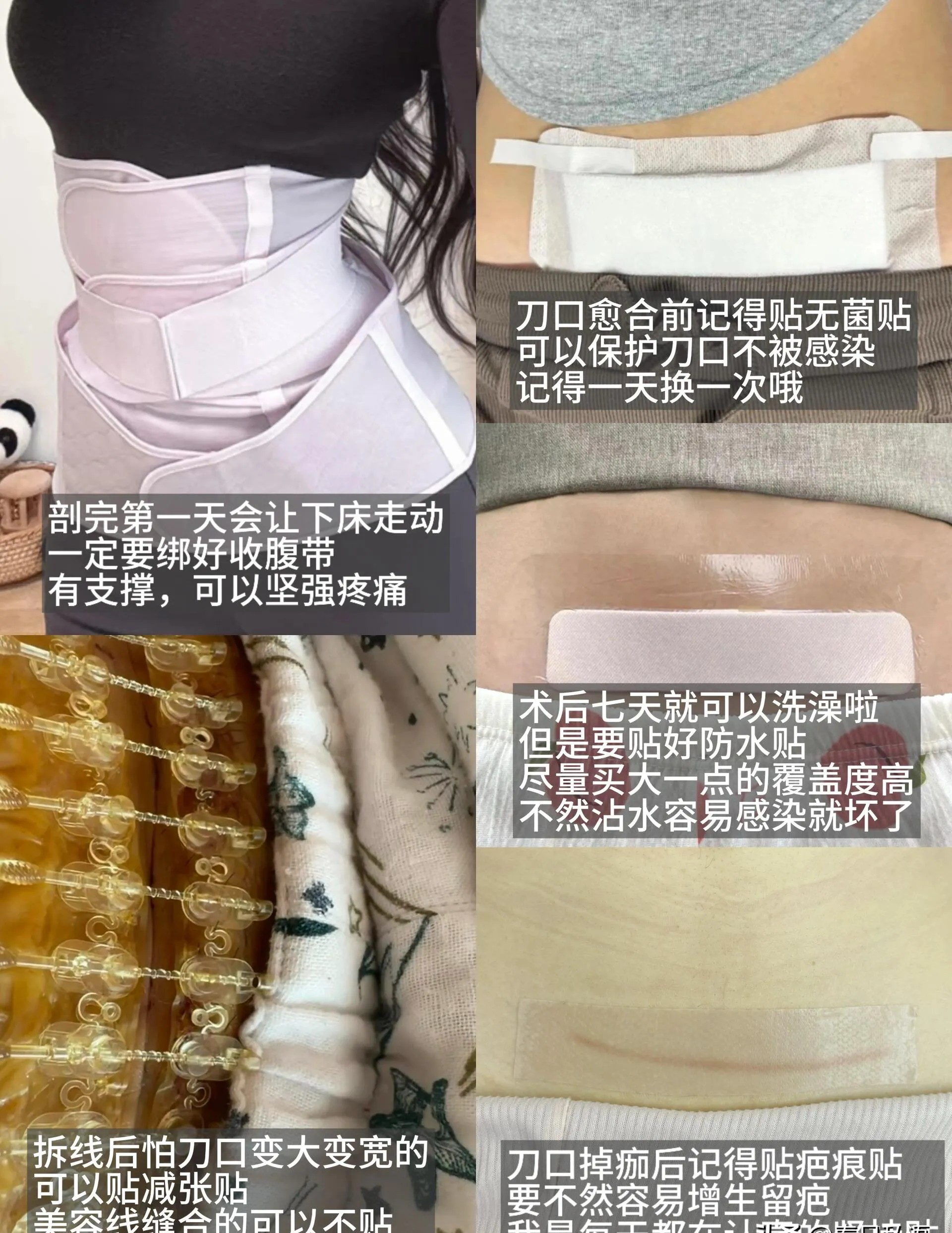 剖腹产的后遗症
