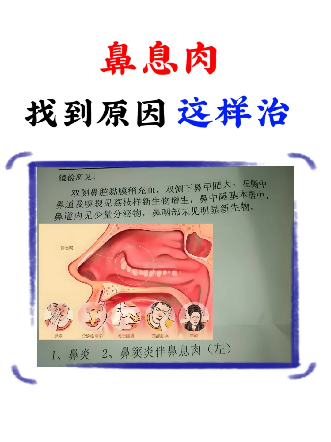 鼻息肉怎么治