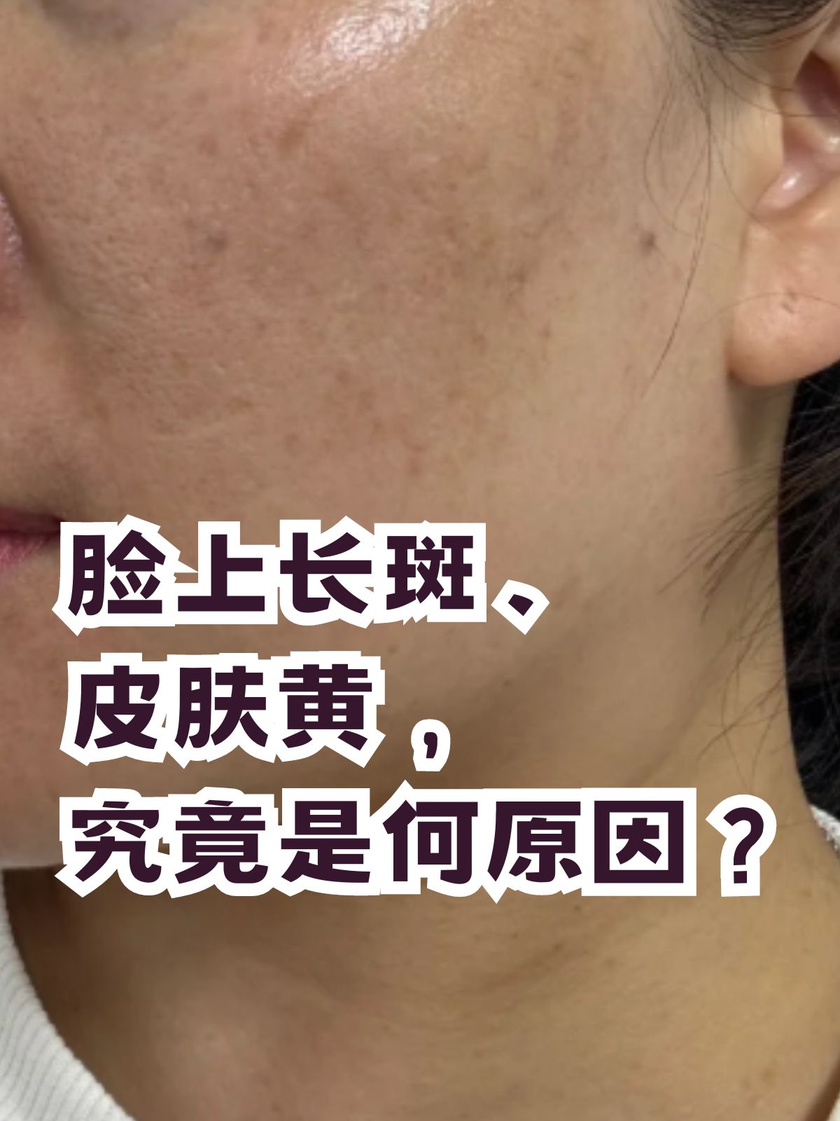 雀斑是由什么原因引起的