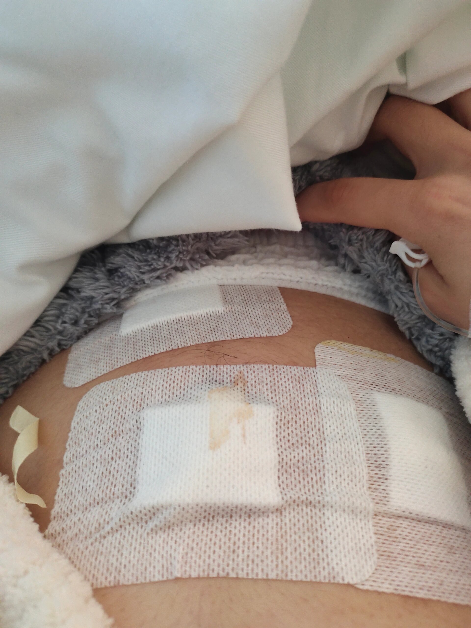 阑尾炎手术后疤痕怎么办