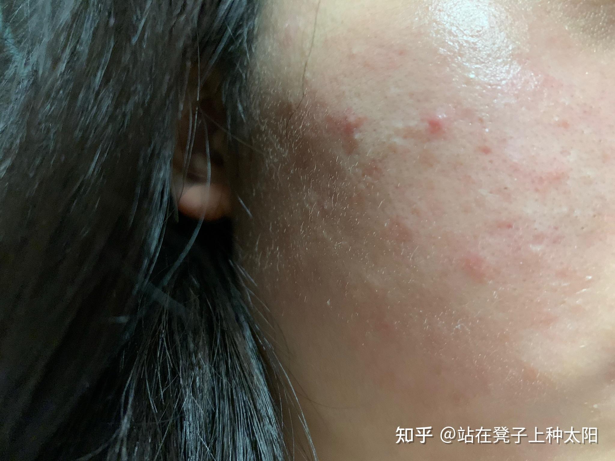 用阿达帕林凝胶爆痘正常吗
