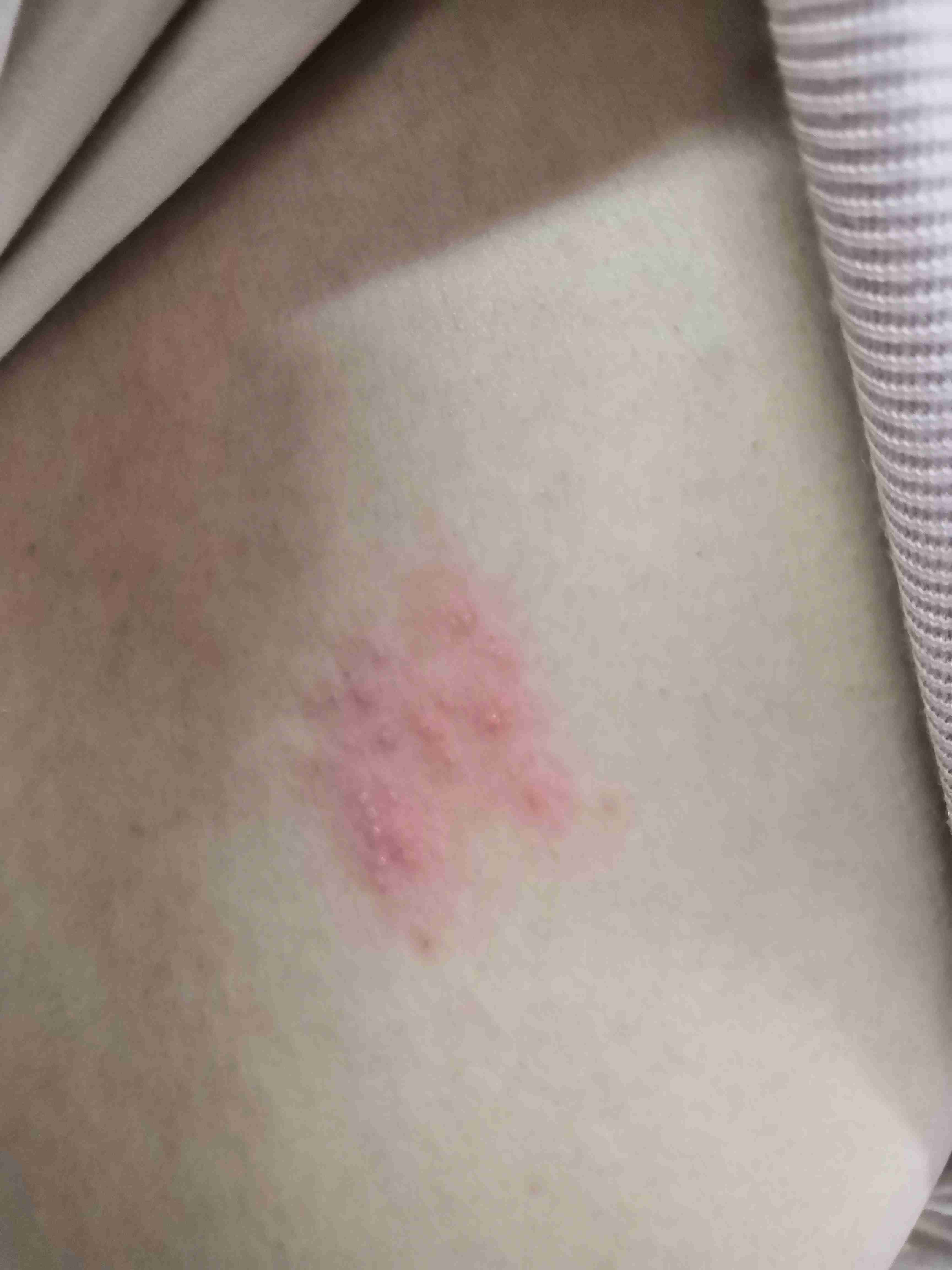 后背起疙瘩,越来越大