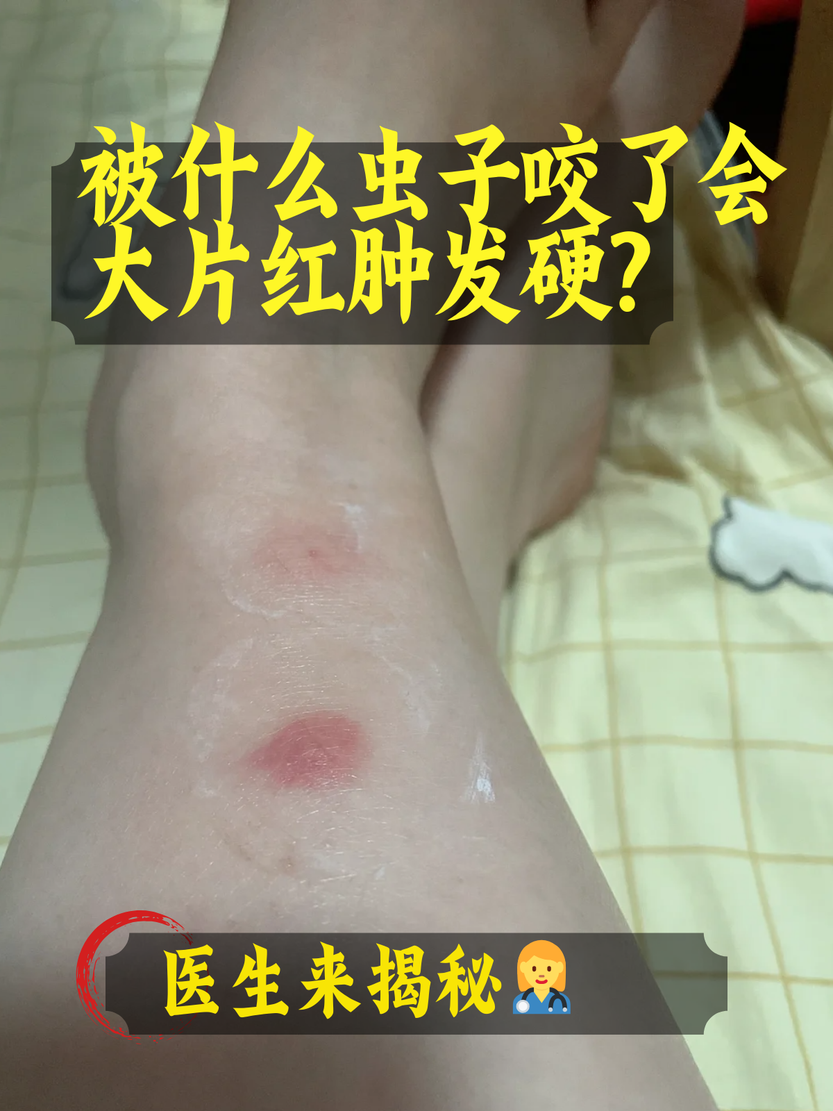 草爬子咬伤中毒的症状
