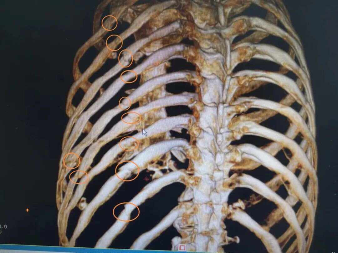 肋骨骨折的症状有哪些