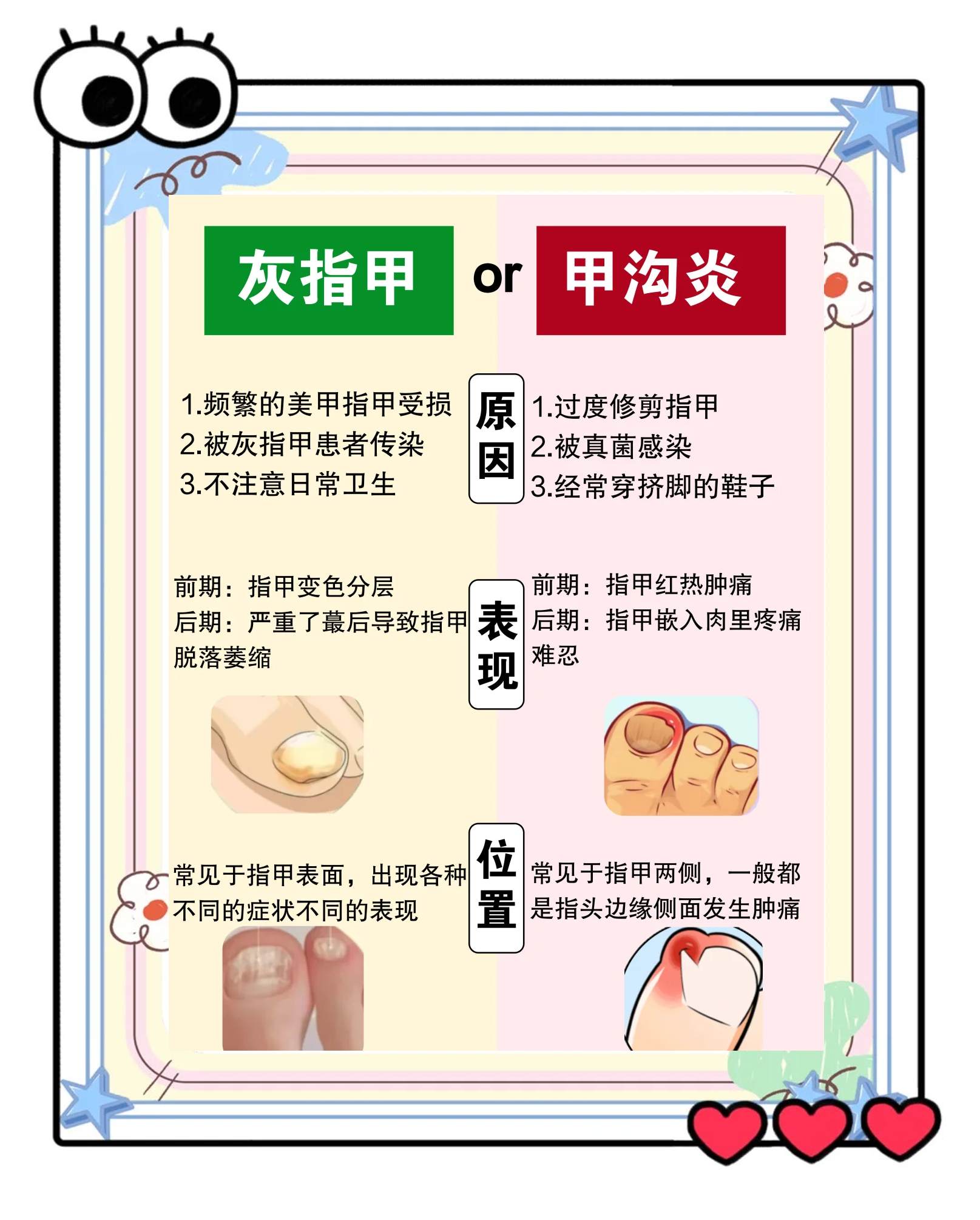 患上了灰指甲如何治疗