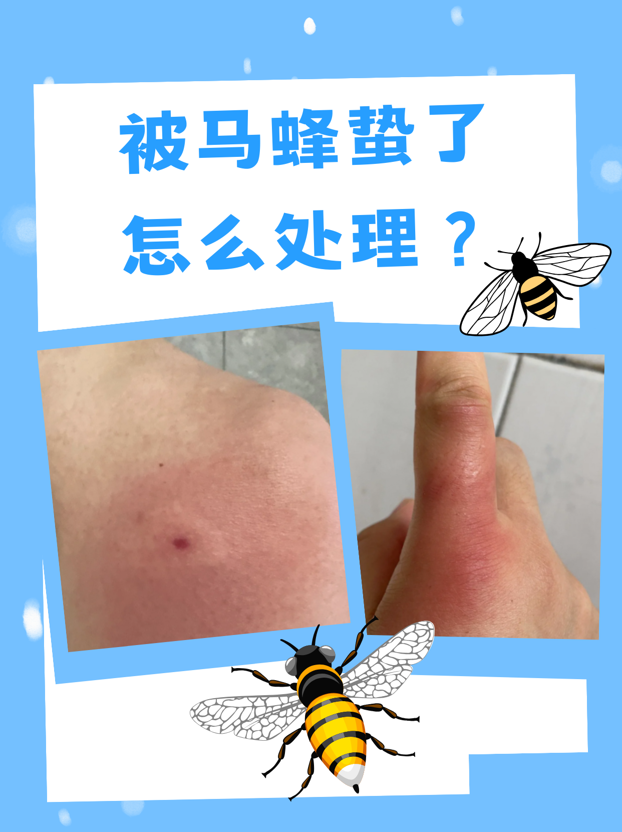 被蜂子蛰了怎么快速消肿
