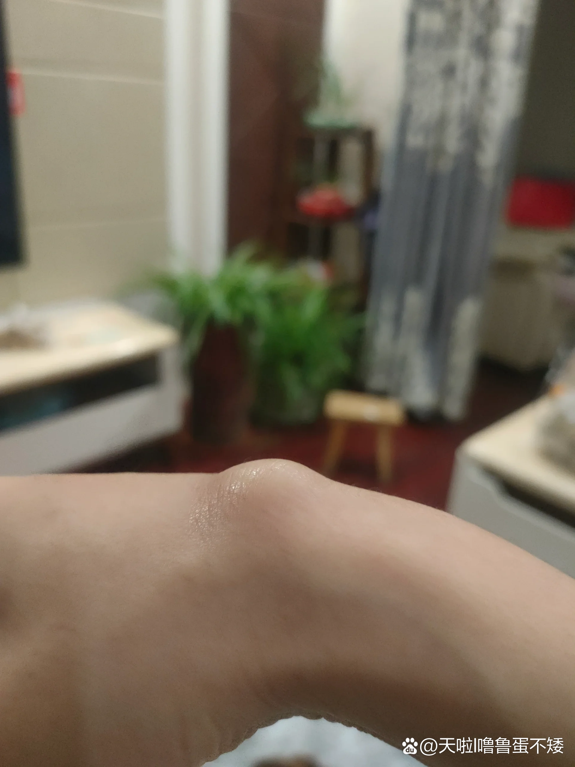 腱鞘囊肿不治疗行吗