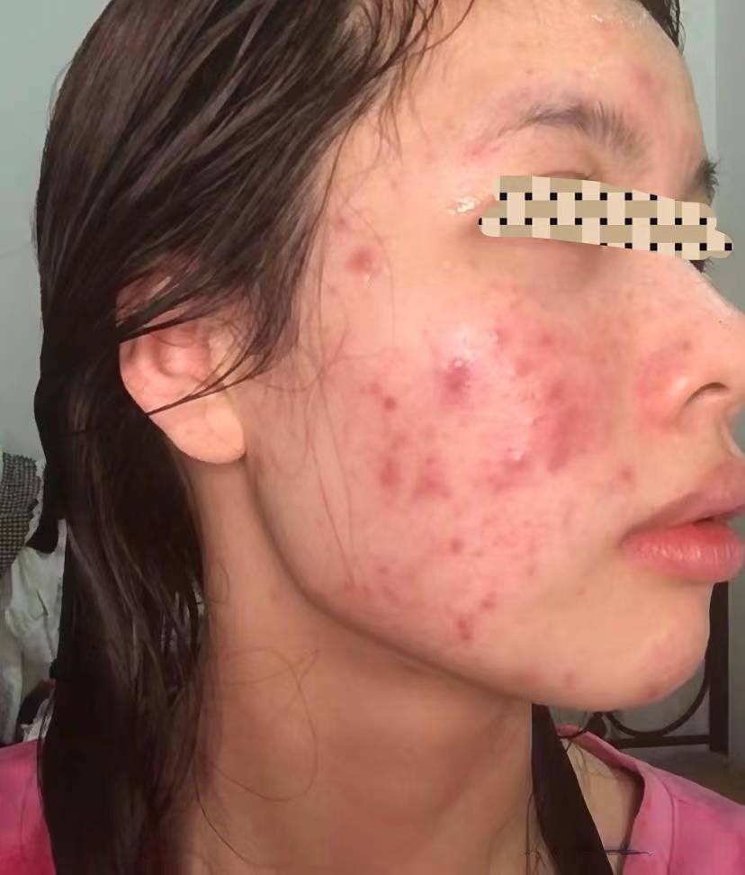红肿的痘痘怎么快速消肿