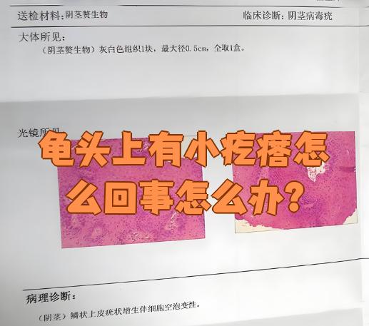 龟头长了菜花是什么样的
