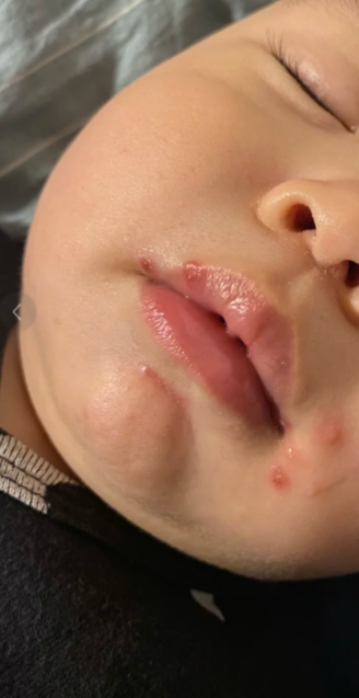 孩子出水痘会传染给大人吗