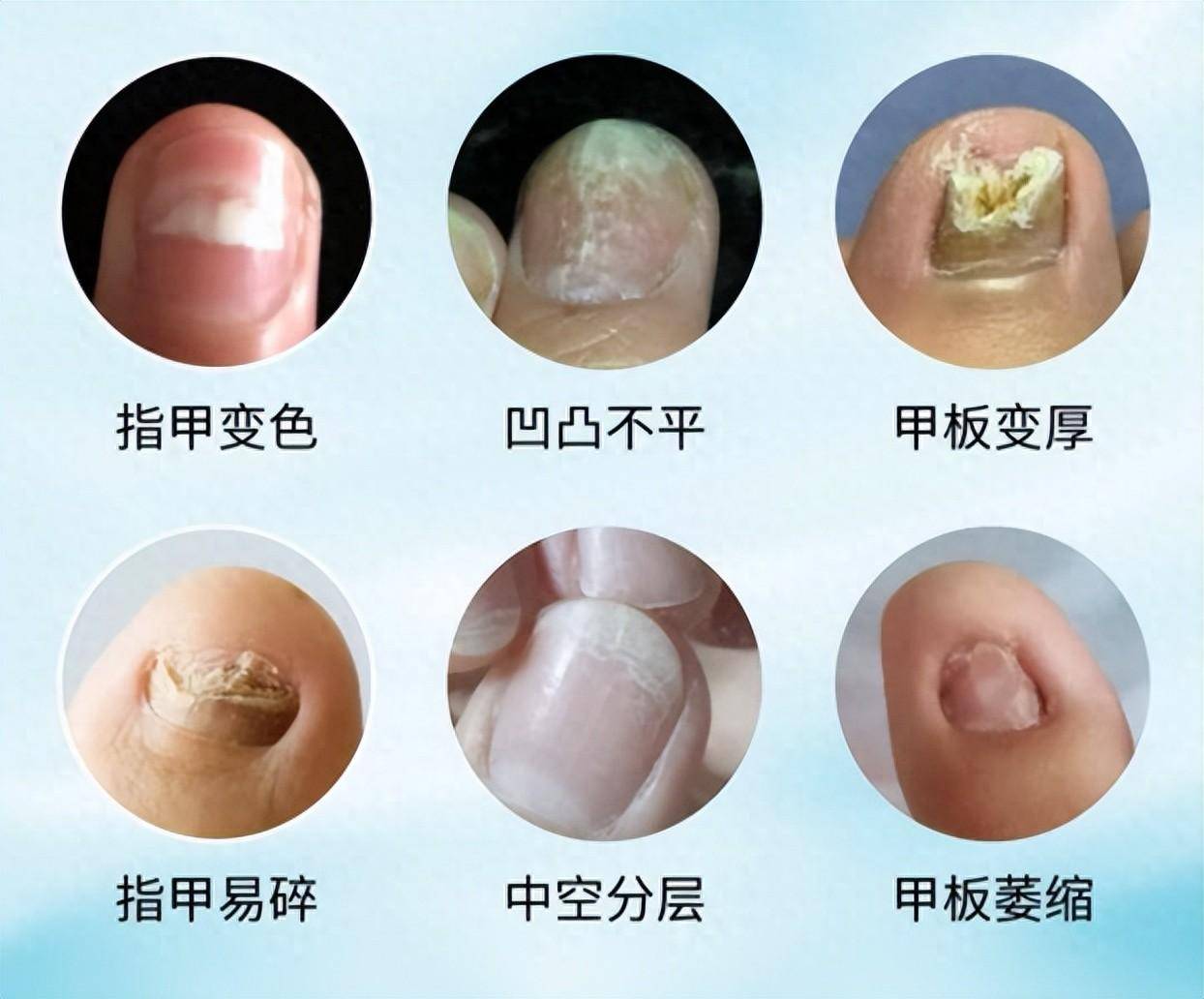 灰指甲能自愈吗?