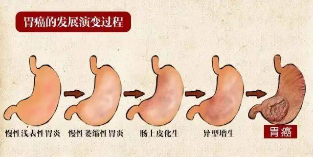 萎缩性胃炎一定会癌变吗