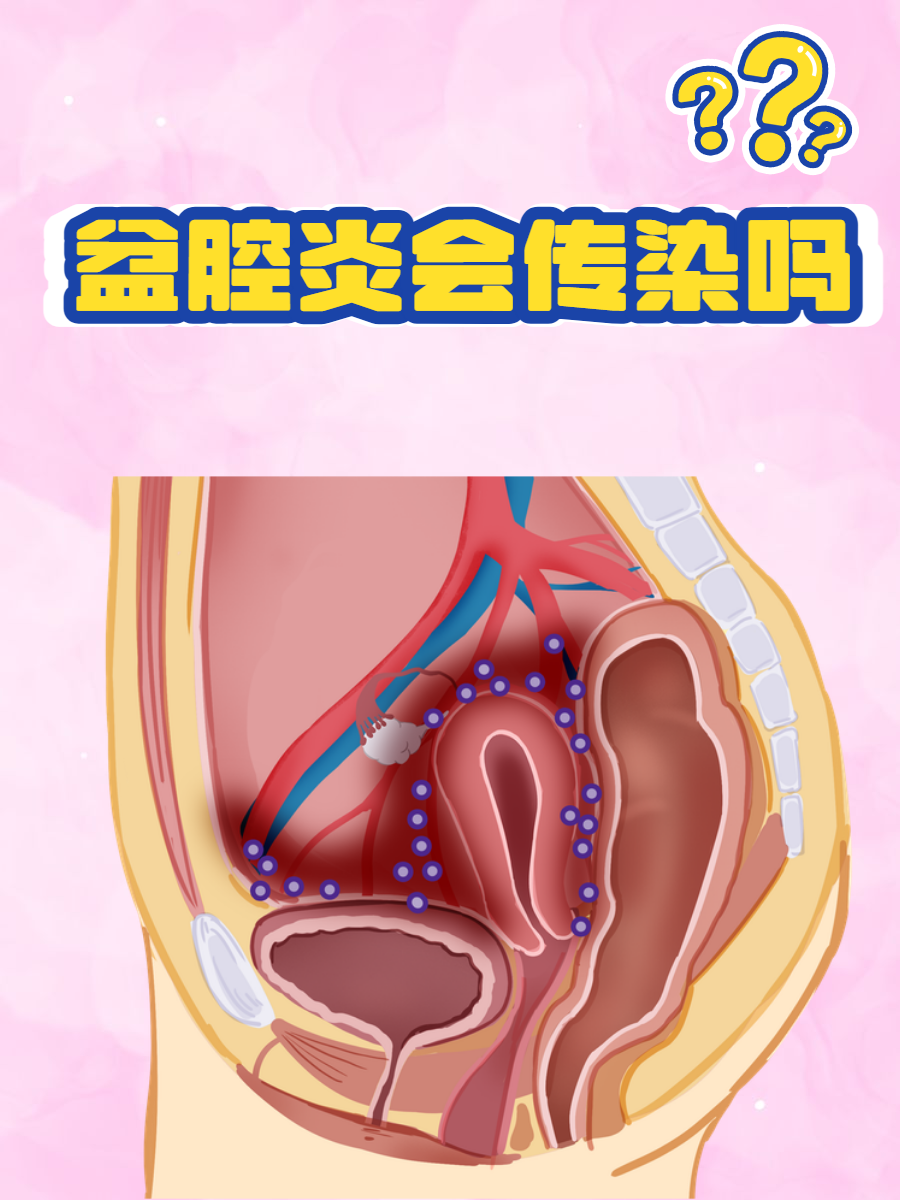 盆腔炎的危害性有哪些