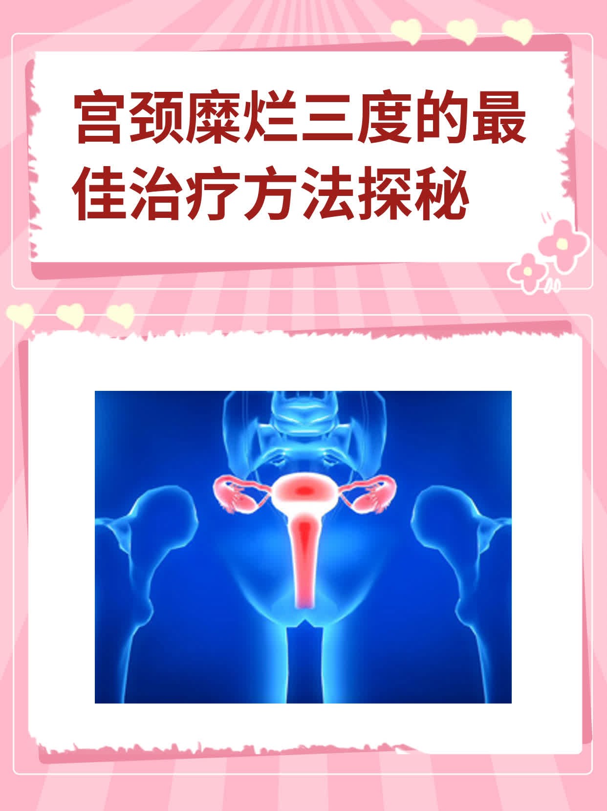 宫颈糜烂会影响怀孕吗