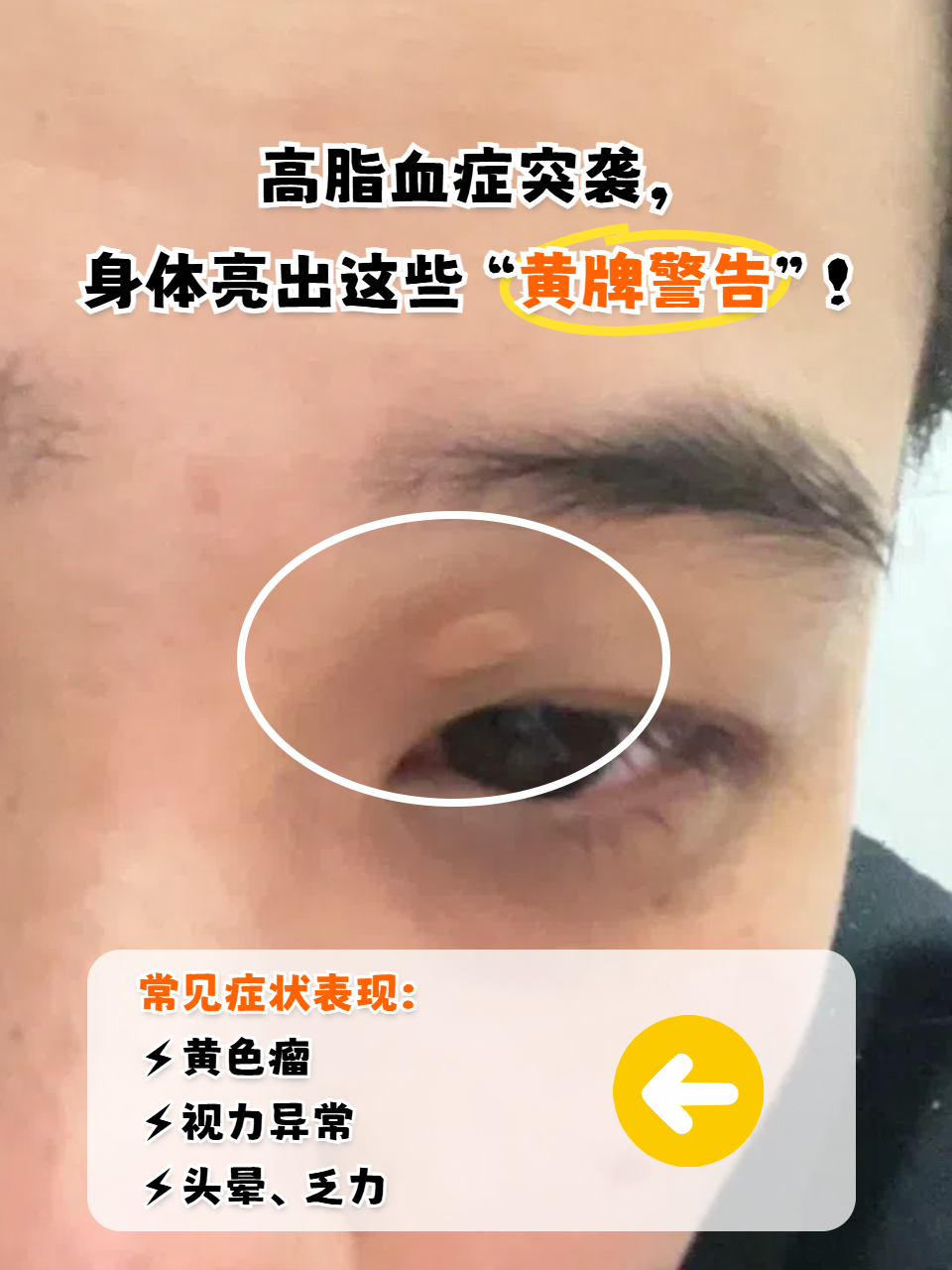 血脂高有什么症状