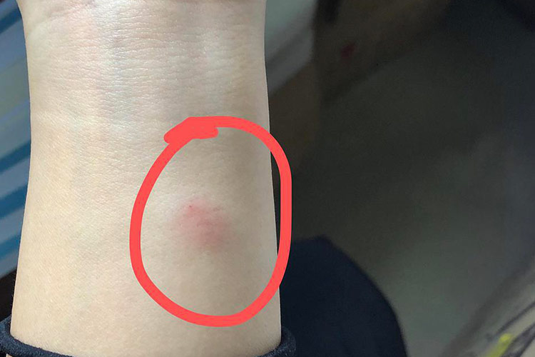 破伤风有什么症状表现