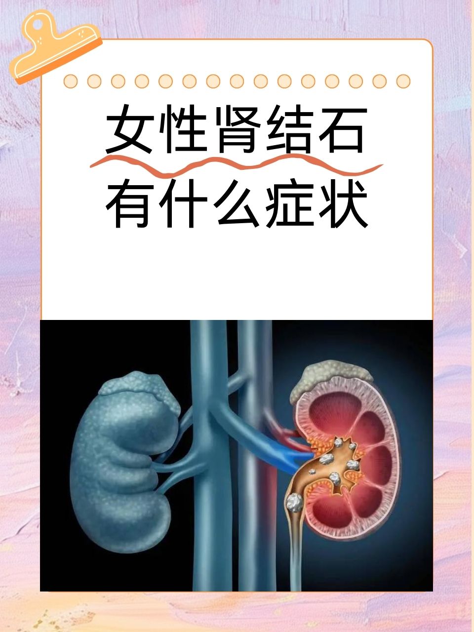 肾结石的早期症状有哪些?