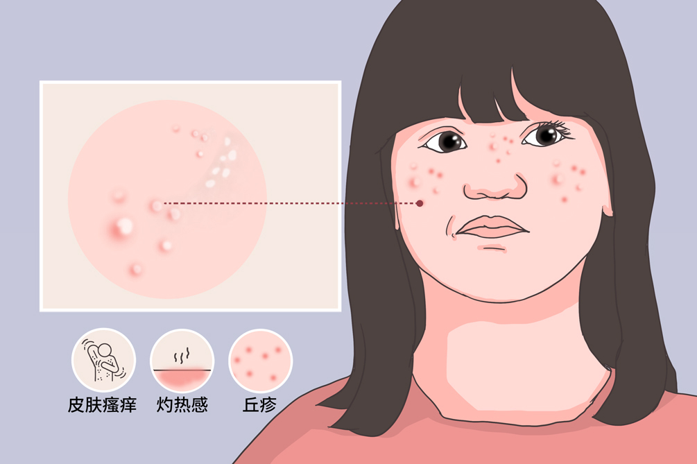 毛发上皮瘤的症状