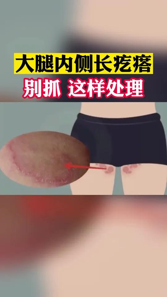 大腿肚内侧红点怎么去除