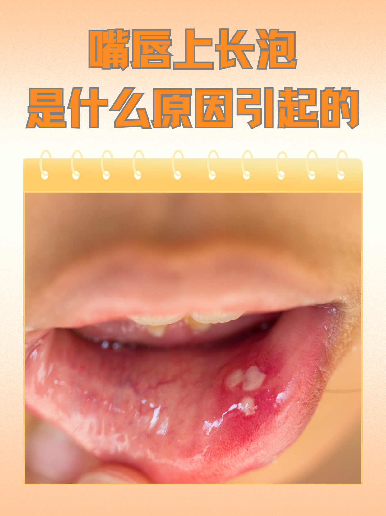 嘴上长水泡怎么办