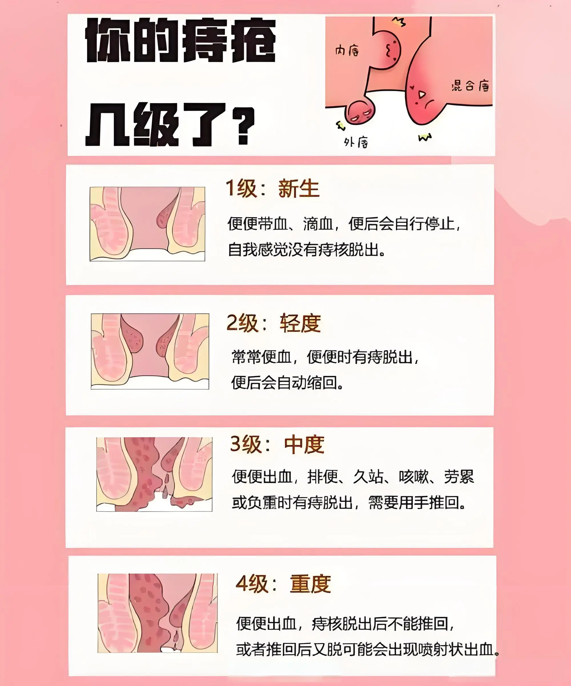痔疮初期能自愈吗