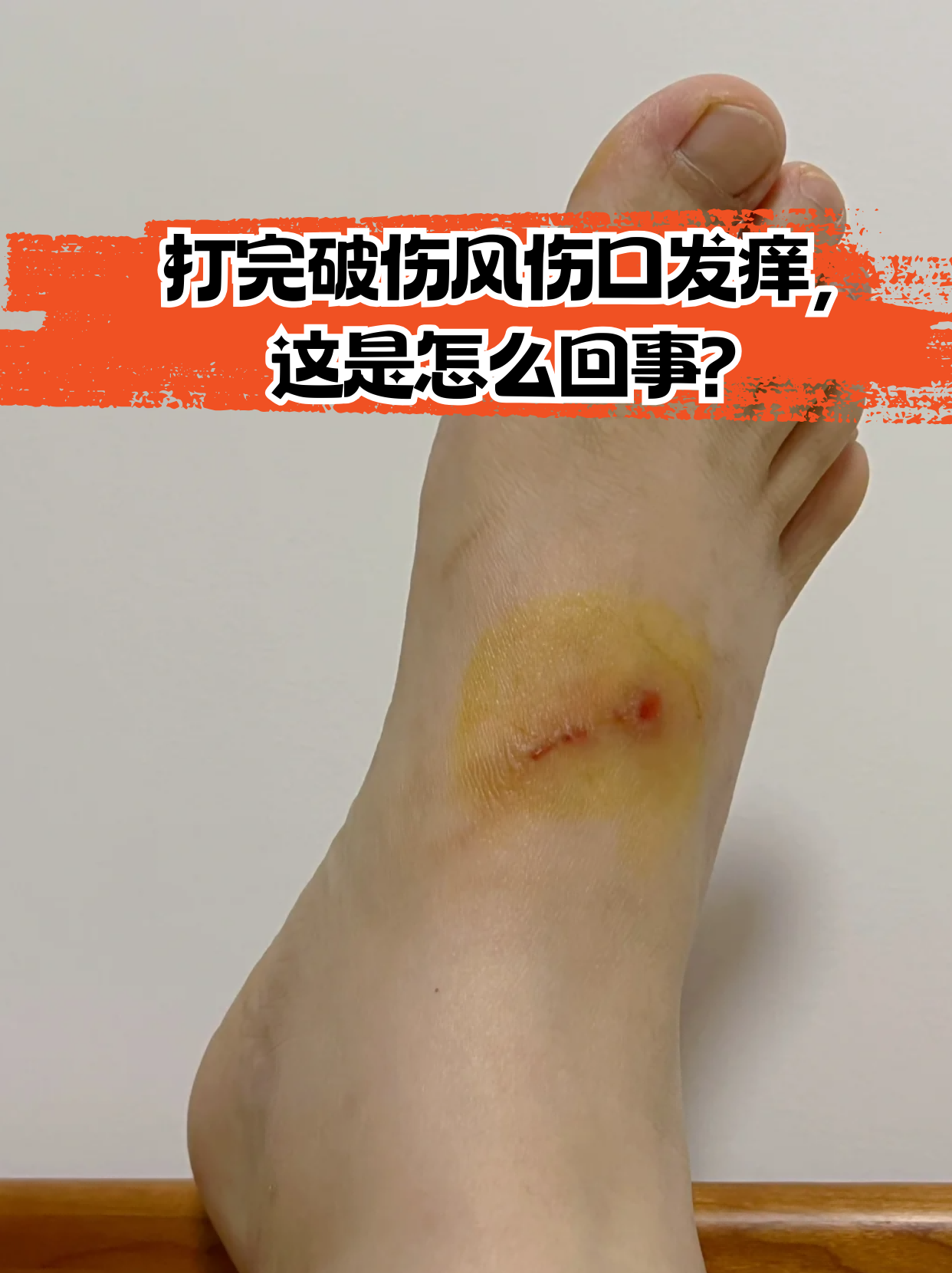 3毫米深伤口要打破伤风针吗?