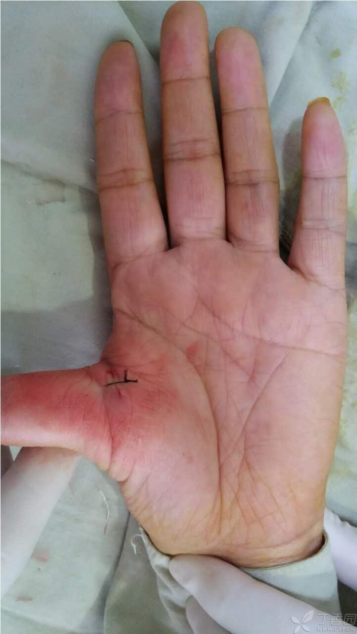 大拇指腱鞘炎能自愈吗