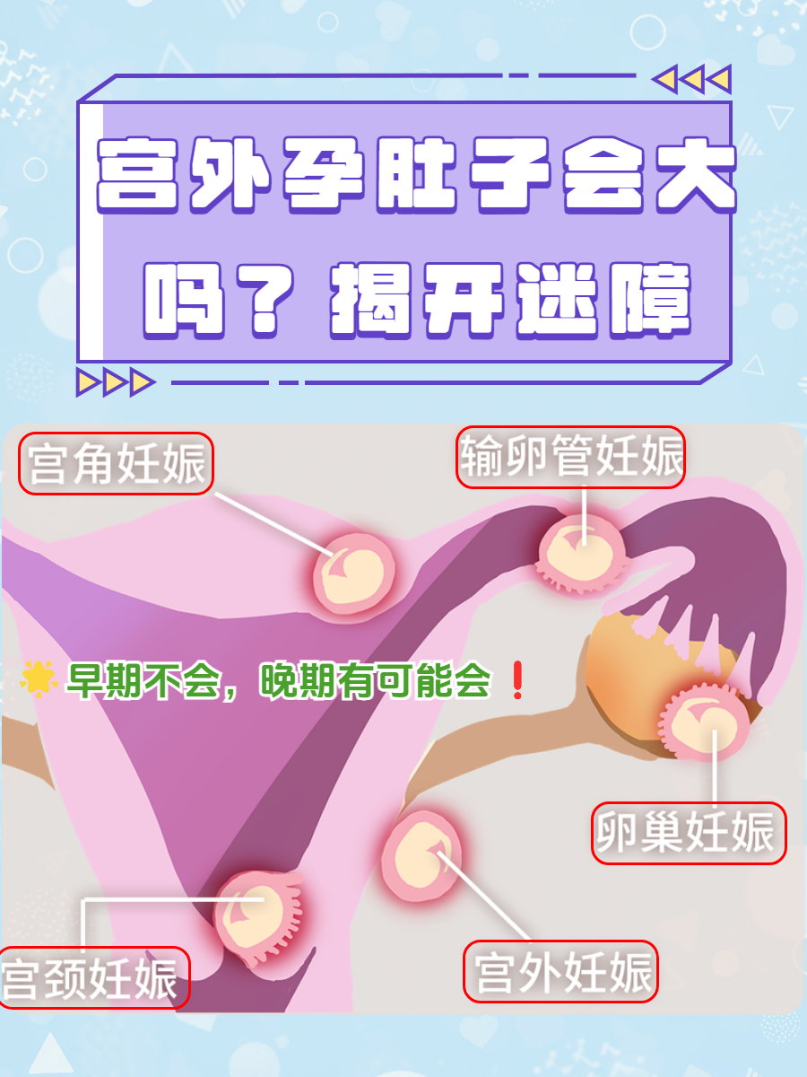 宫外孕一个月怎么打掉