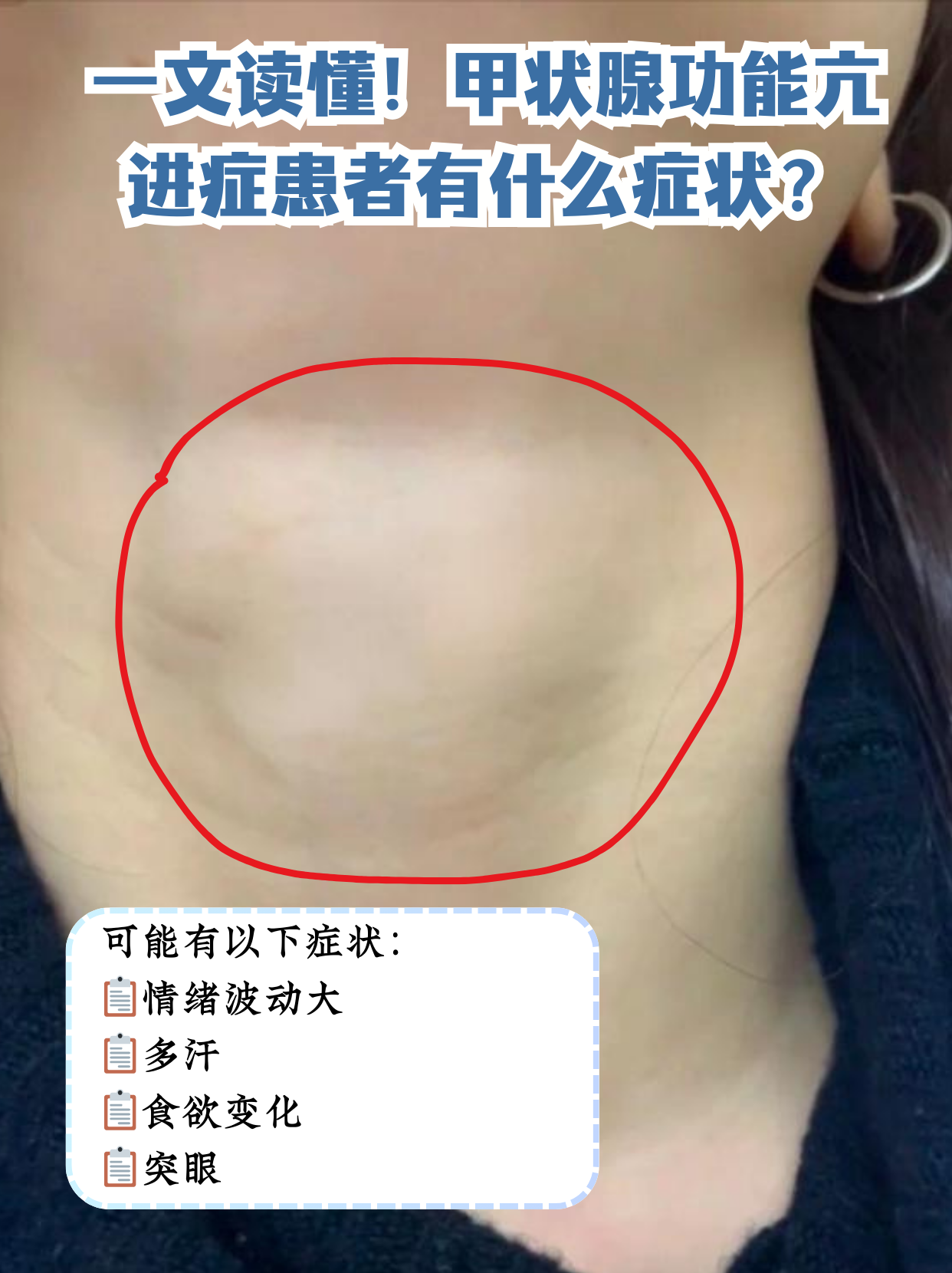 甲状腺功能亢进症是什么病
