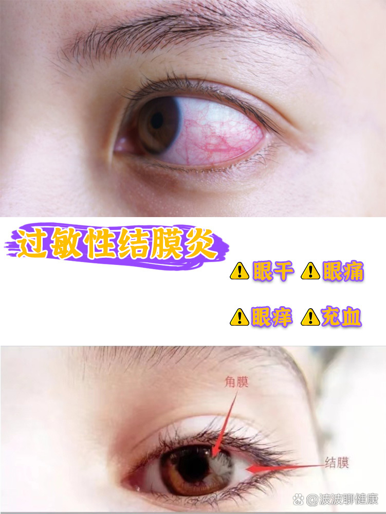 过敏性结膜炎能自愈吗