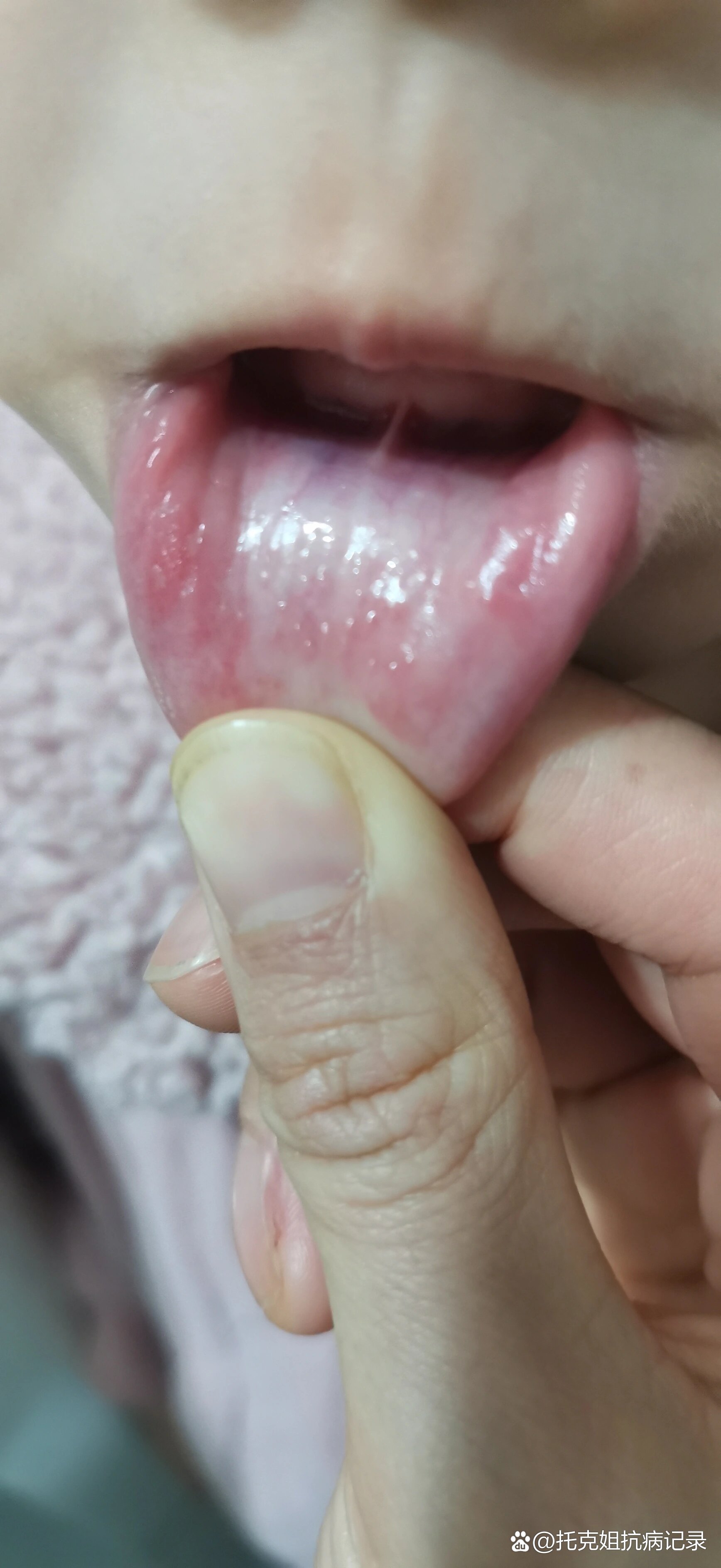 嘴唇里面长了一个肉疙瘩是什么情况