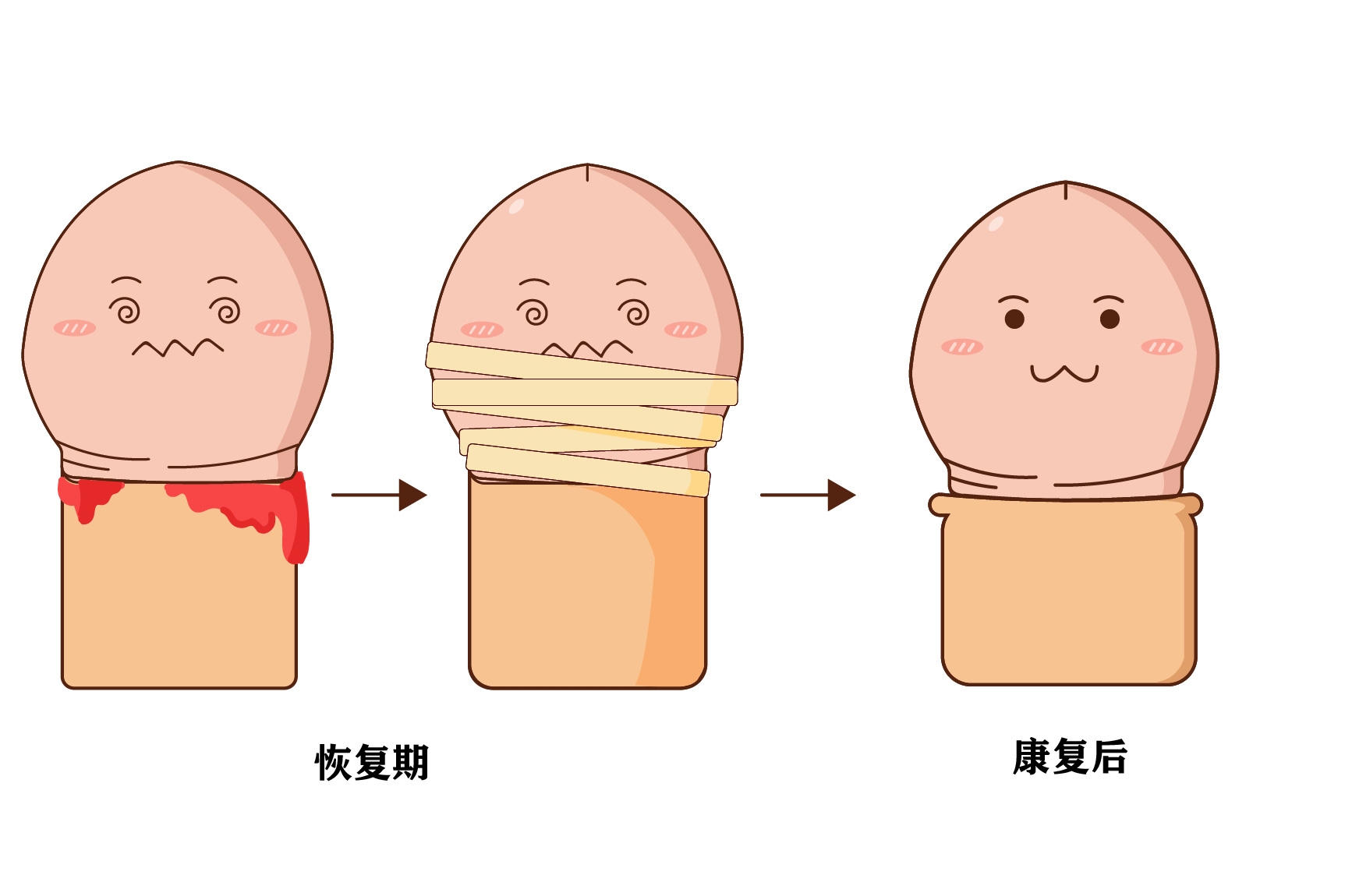 包皮手术后多久可以洗澡